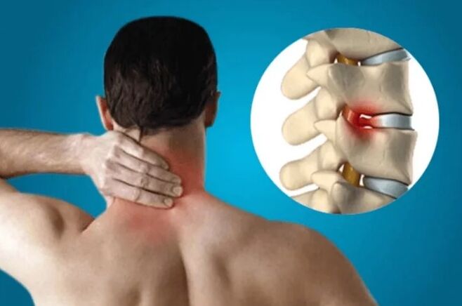 Osteochondróza chrbtice