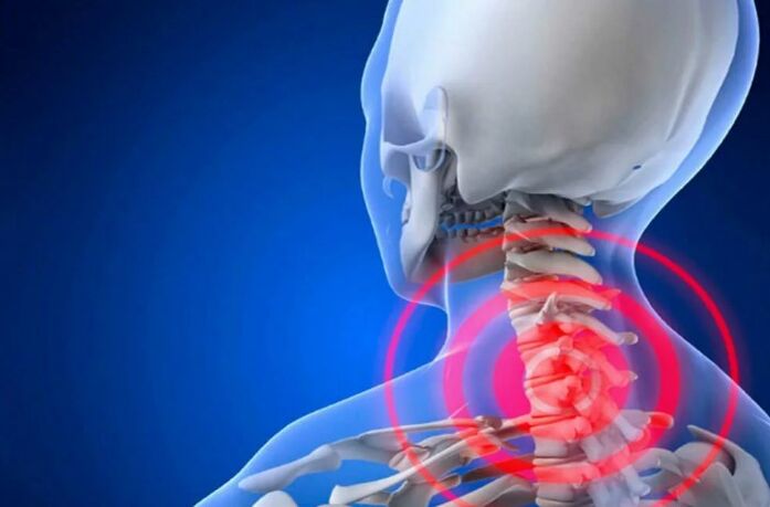 Osteochondróza krčnej chrbtice