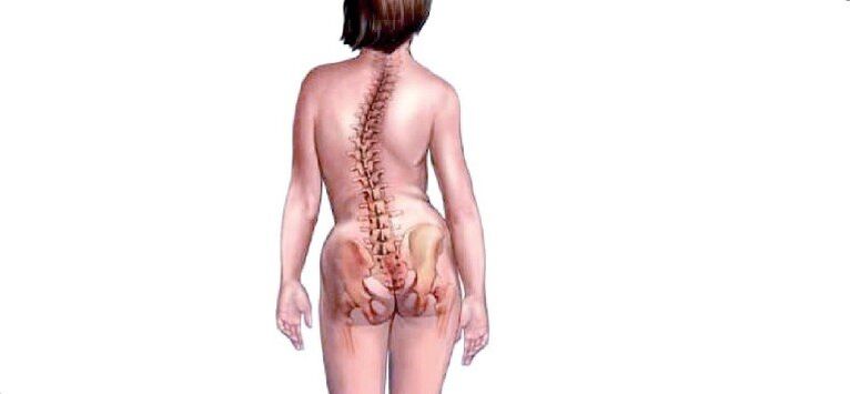 osteochondróza