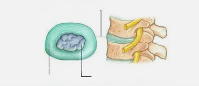 Povaha osteochondrózy