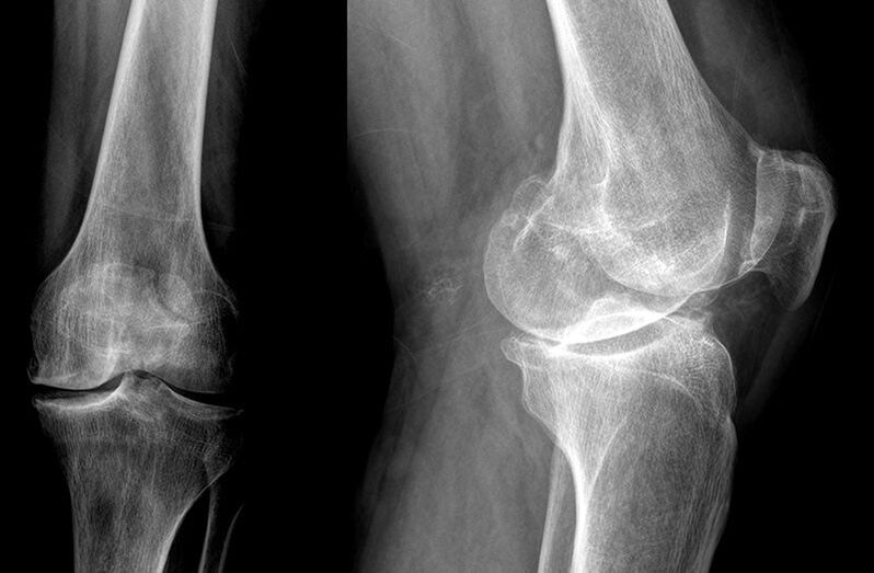 diagnostika artrózy kĺbov